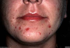 acne-akne-dermatologija-bubuljice-dermatolog-lecenje akni