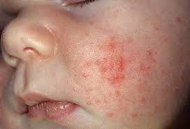 acne-akne-dermatologija-bubuljice-dermatolog-lecenje akni