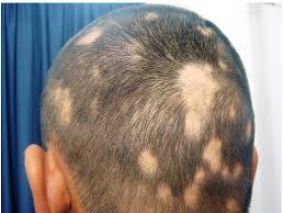 Alopecia areata