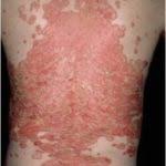 psorijaza-lecenje-psorijaze-dermatolog