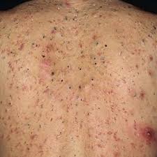 acne-akne-dermatologija-bubuljice-dermatolog-lecenje akni