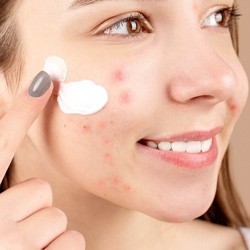 akne-acne-dermatologija-bubuljice-dermatolog-lecenje akni